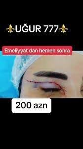 “UĞUR 777” estetik mərkəzində tibbi təhsili olmayan “kosmetoloqlar” lisenziyasız “həkimlər” necə prosedurları həyata keçirir?
