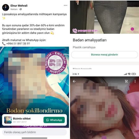 Sertifikatı olmasa da, özünü plastik cərrah kimi reklam edir: Elnur Mehrəli qanunu saymır? - DƏLİXANADIR, VALLAH...