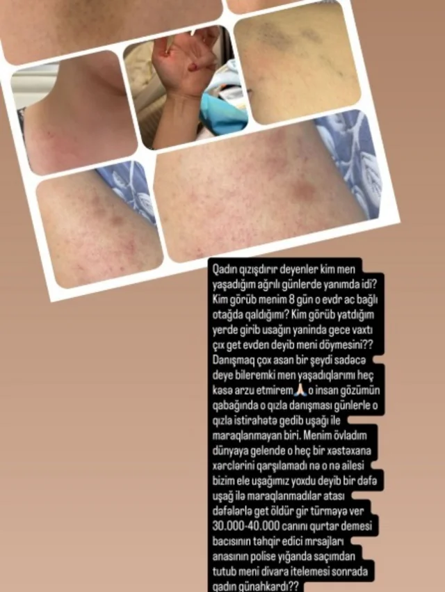 Rəqqas əri tərəfindən döyüldüyünü iddia edən qadın yeni faktları açıqladı